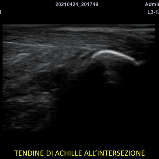 TendinediAchilleInter