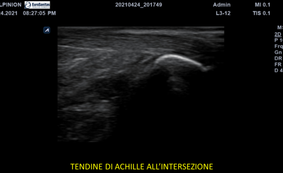 TendinediAchilleInter